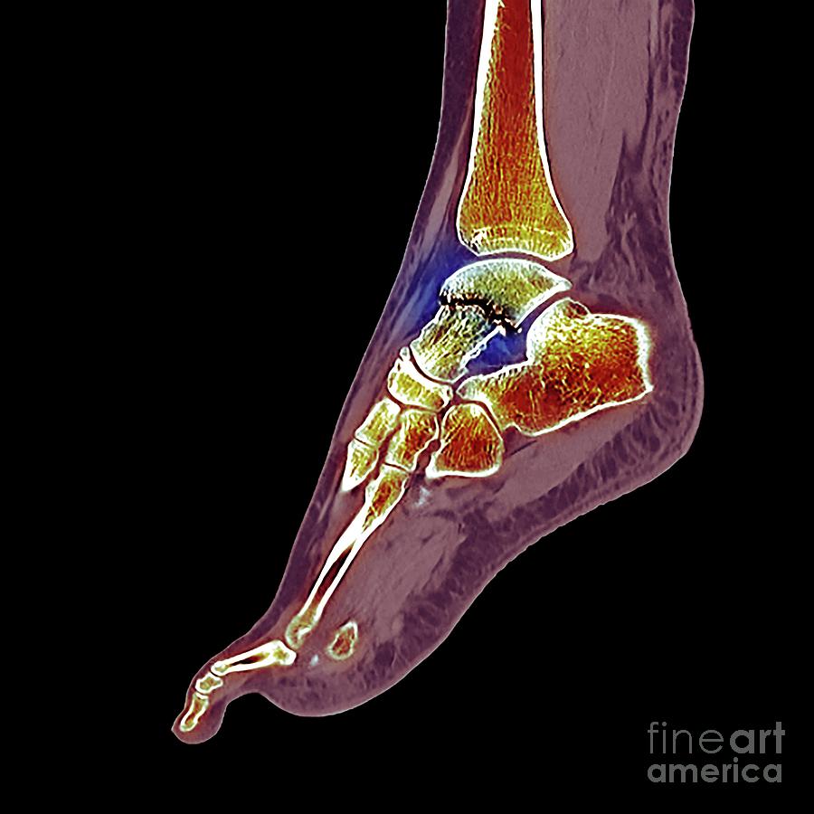 Fractured Ankle Bone Photograph by Dr P. Marazzi/science Photo Library