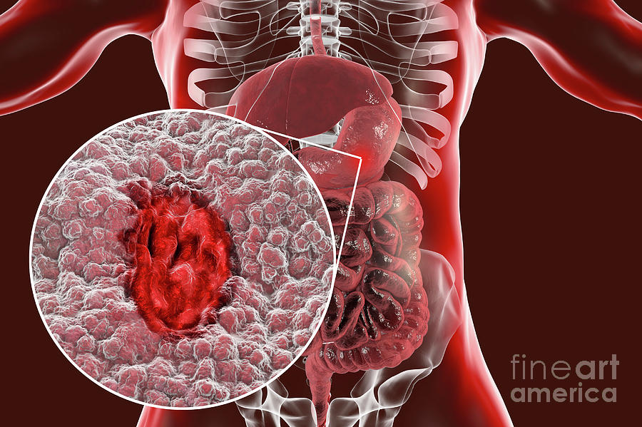 figure-2-from-pathophysiology-of-gastric-ulcer-development-and-healing