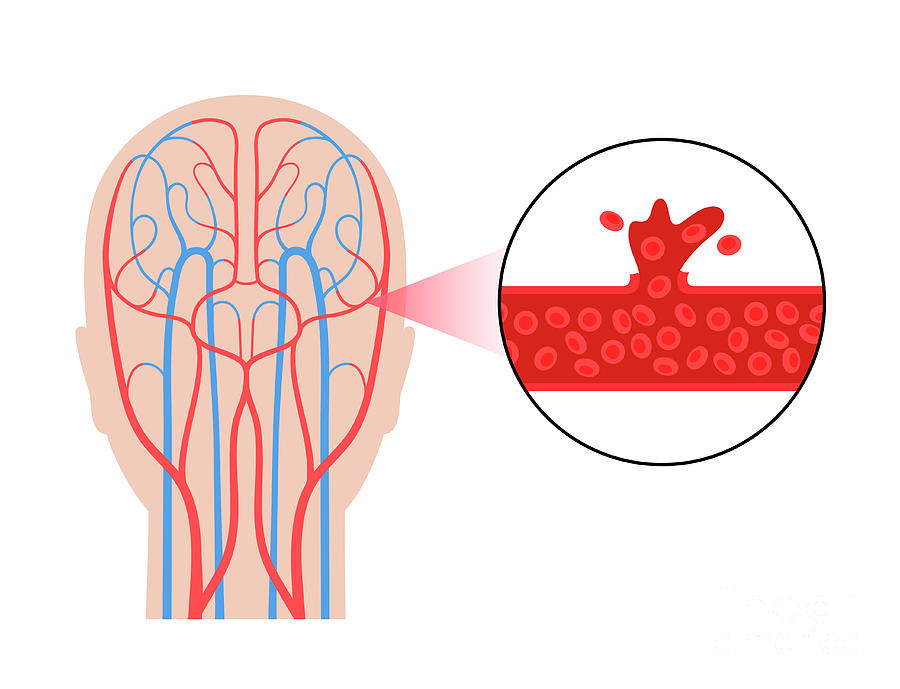 Haemorrhagic Stroke Photograph by Pikovit / Science Photo Library ...