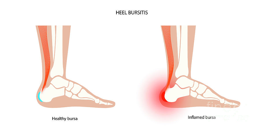 Heel Bursitis Photograph by Pikovit / Science Photo Library - Pixels