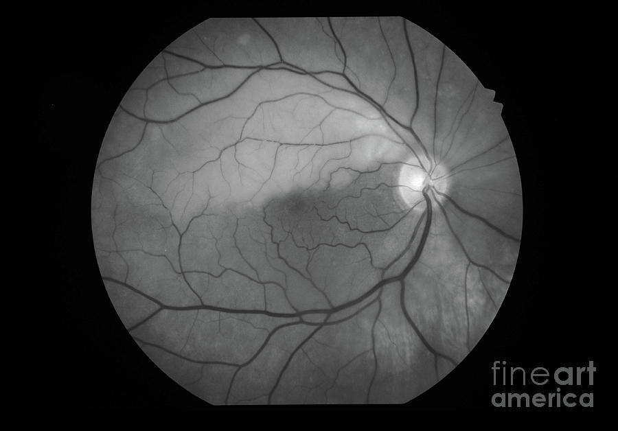 Hemispheric Retinal Artery Occlusion Photograph by Alan Frohlichstein ...