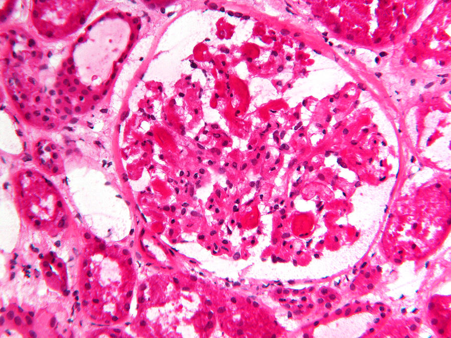 Research Digital Art - Histology Micrograph  Of Renal Failure, Showing Interstitial Nephritis In Tissue Of Kidney With H&e Stain #4 by Michael J. Klein, M.d.