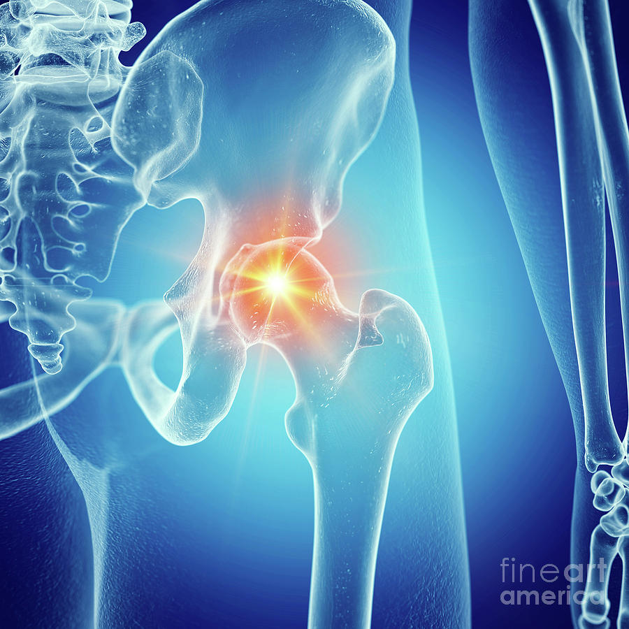 Illustration Of A Painful Hip Joint #4 Photograph by Sebastian ...