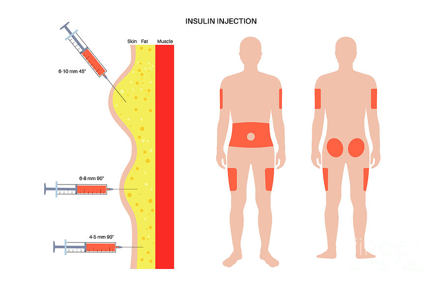 Insulin Injection Sites Photograph By Pikovit Science Photo Library   4 Insulin Injection Sites Pikovit Science Photo Library 