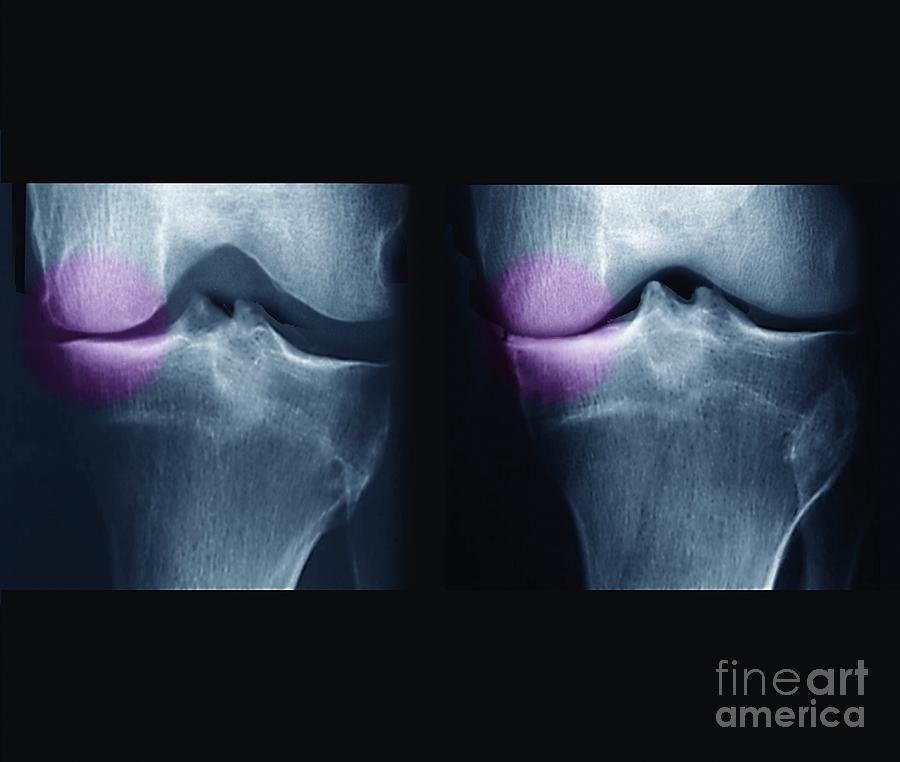 Knee Osteoarthritis #4 Photograph by Zephyr/science Photo Library