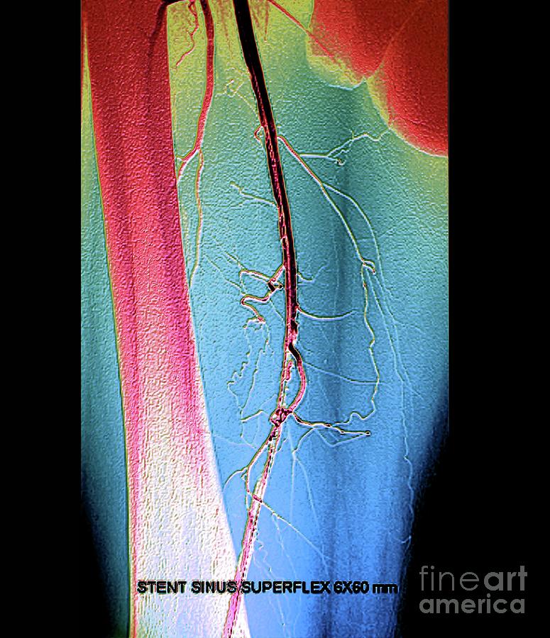 Leg Artery Angioplasty Photograph By Zephyrscience Photo Library Fine Art America 8912