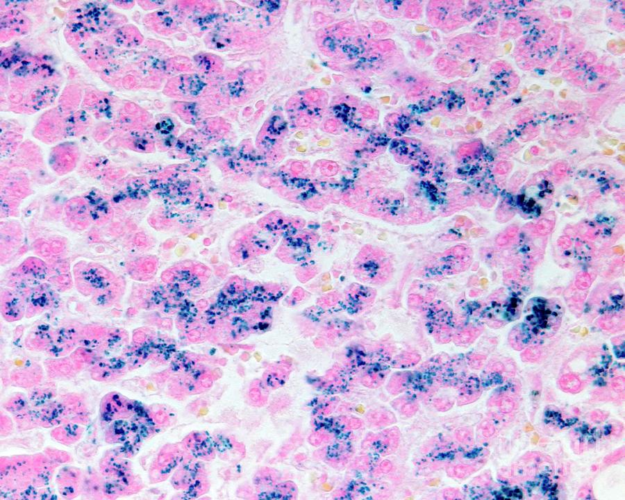 Biopsy Photograph - Liver Haemochromatosis #4 by Jose Calvo/science Photo Library