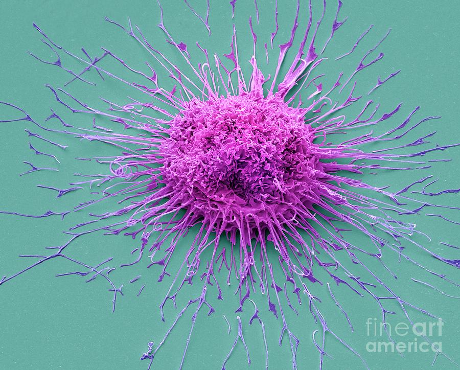 Lung Cancer Cell Photograph by Steve Gschmeissner/science Photo Library ...