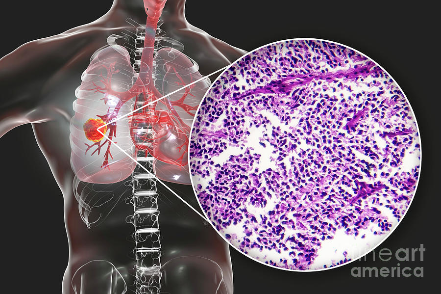 Lung Cancer Photograph by Kateryna Kon/science Photo Library | Fine Art ...