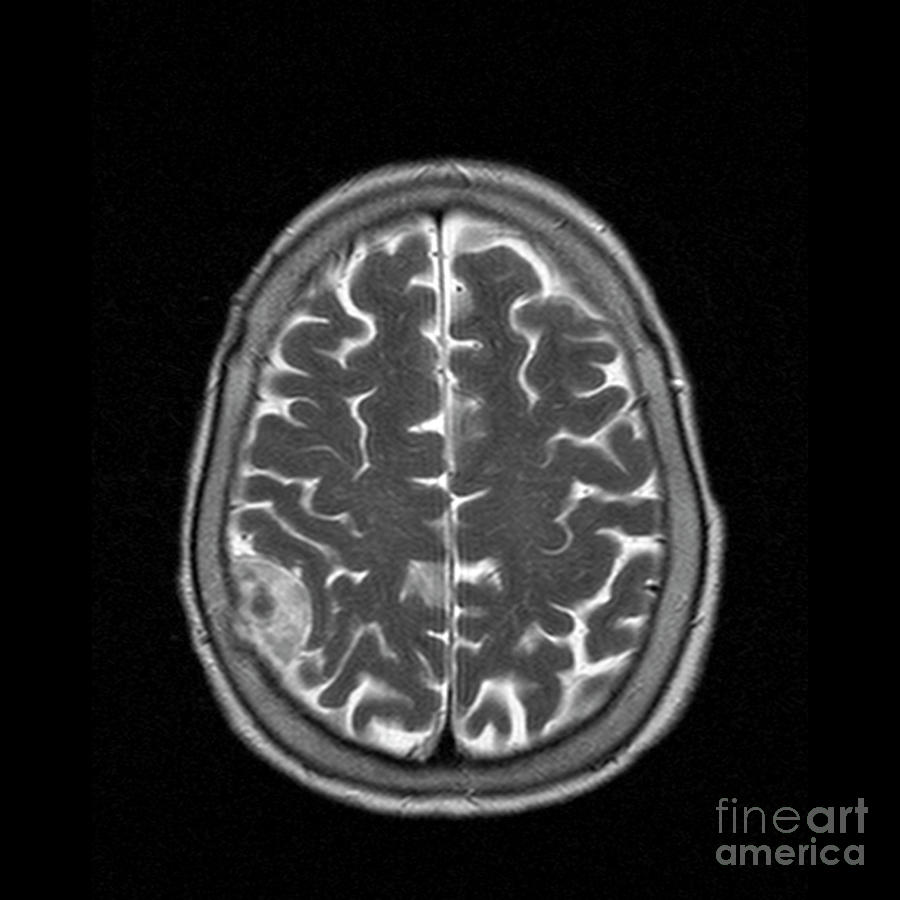 Meningioma Tumour Photograph by Simon Fraser/science Photo Library ...