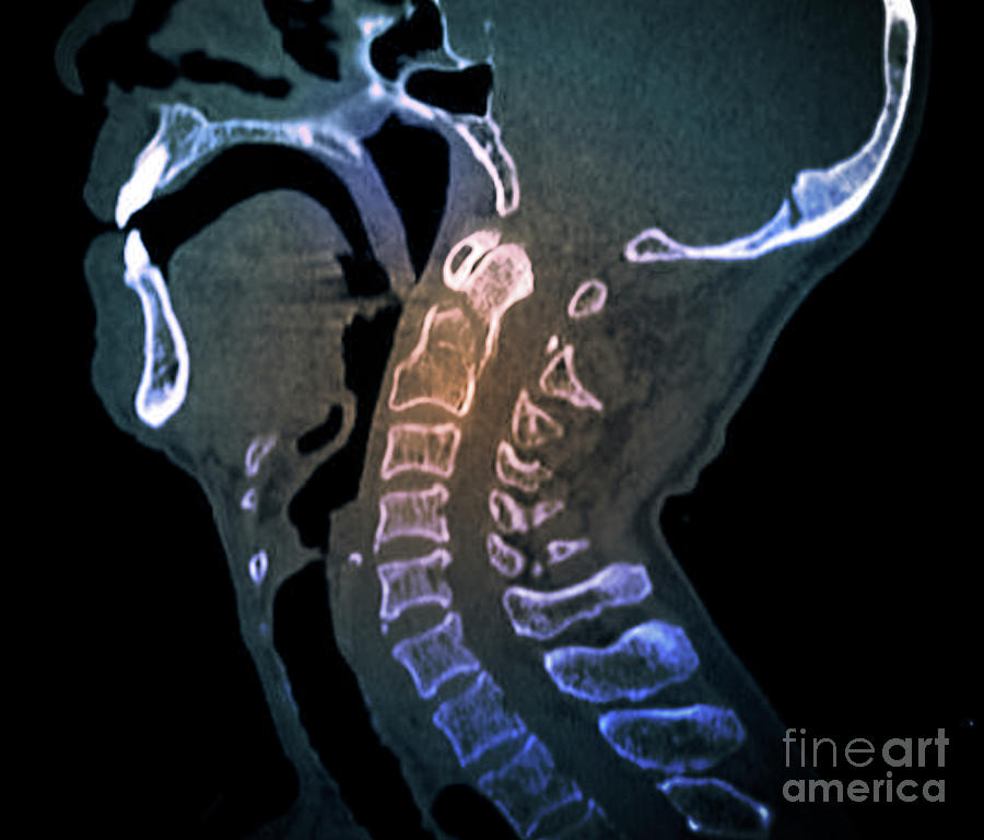 Odontoid Process Fracture #4 Photograph by Zephyr/science Photo Library