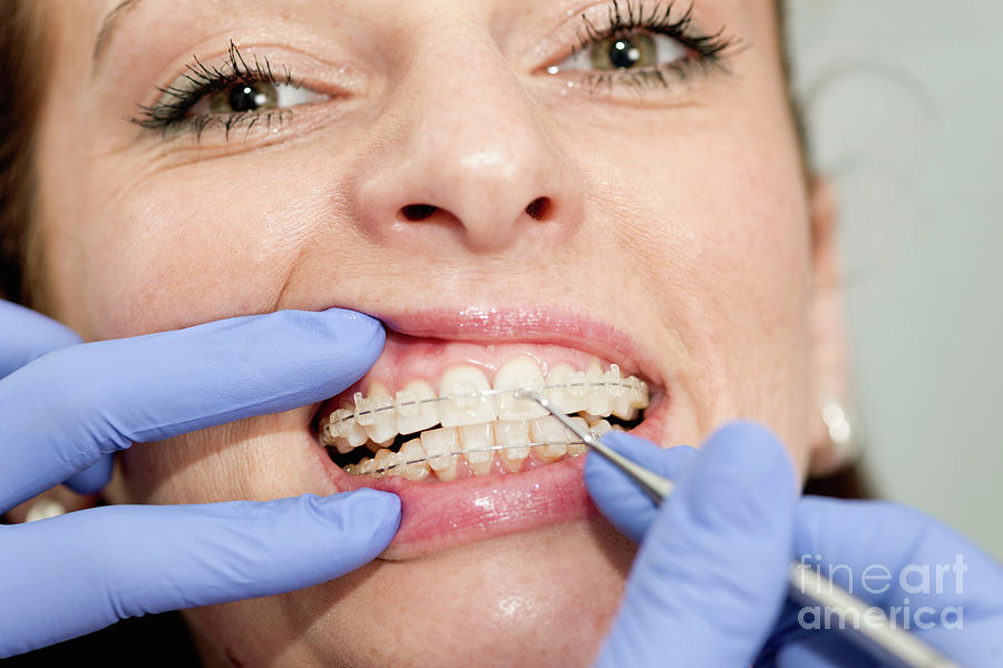 Braces Photograph - Orthodontist Tightening Braces #4 by Microgen Images/science Photo Library
