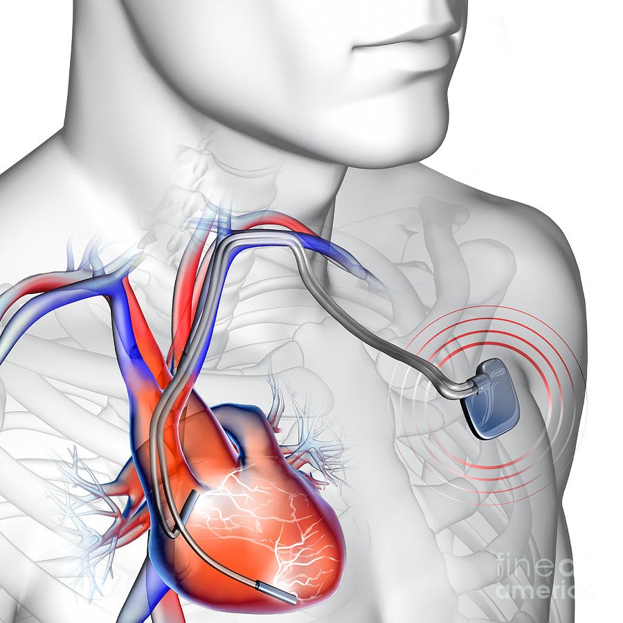 Pacemaker Photograph by Fernando Da Cunha/science Photo Library - Fine ...