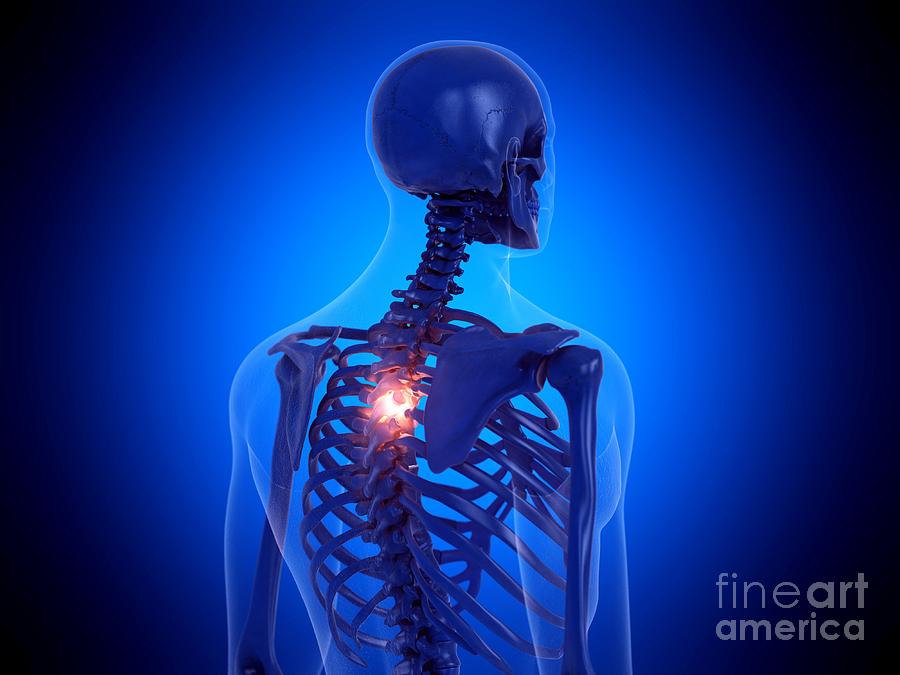 Painful Spine #4 Photograph by Sebastian Kaulitzki/science Photo Library