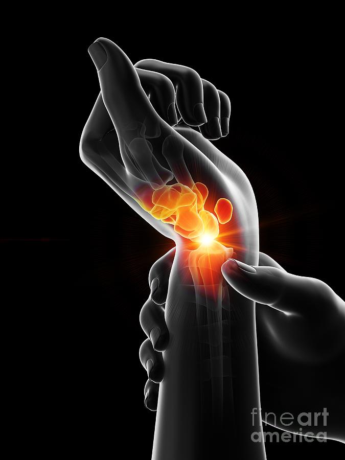Painful Wrist #4 Photograph by Sebastian Kaulitzki/science Photo Library