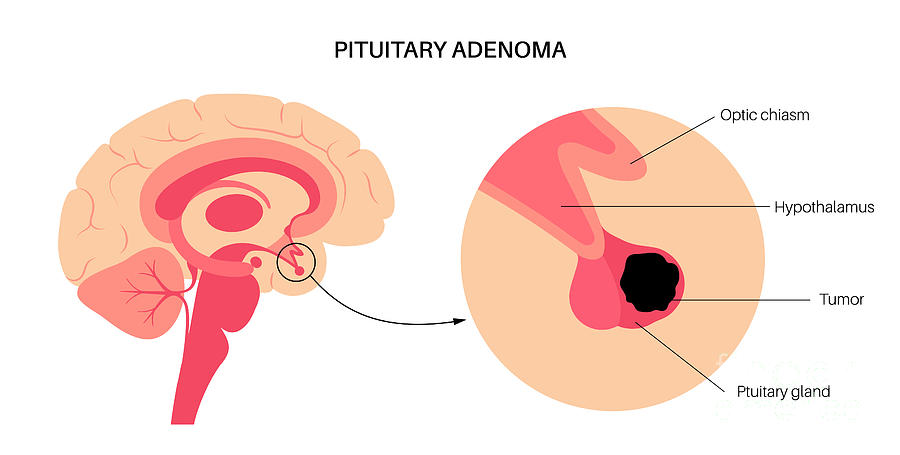 Pituitary Adenoma Cancer Photograph By Pikovit Science Photo Library Fine Art America 2624