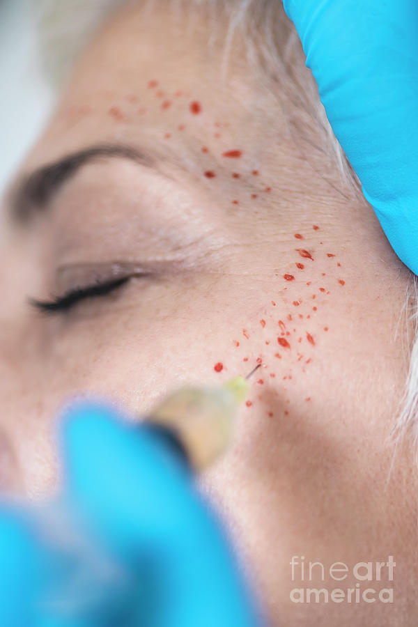 Prp Photograph - Platelet-rich Plasma Facial Treatment #4 by Microgen Images/science Photo Library