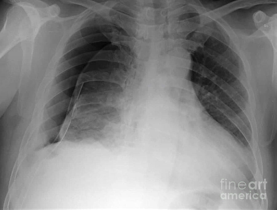 Pneumothorax Photograph by Rajaaisya/science Photo Library - Fine Art ...