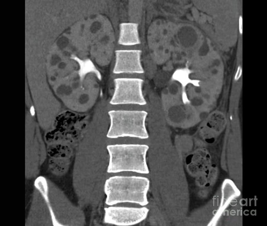 Polycystic Kidneys Photograph by Zephyr/science Photo Library - Fine ...