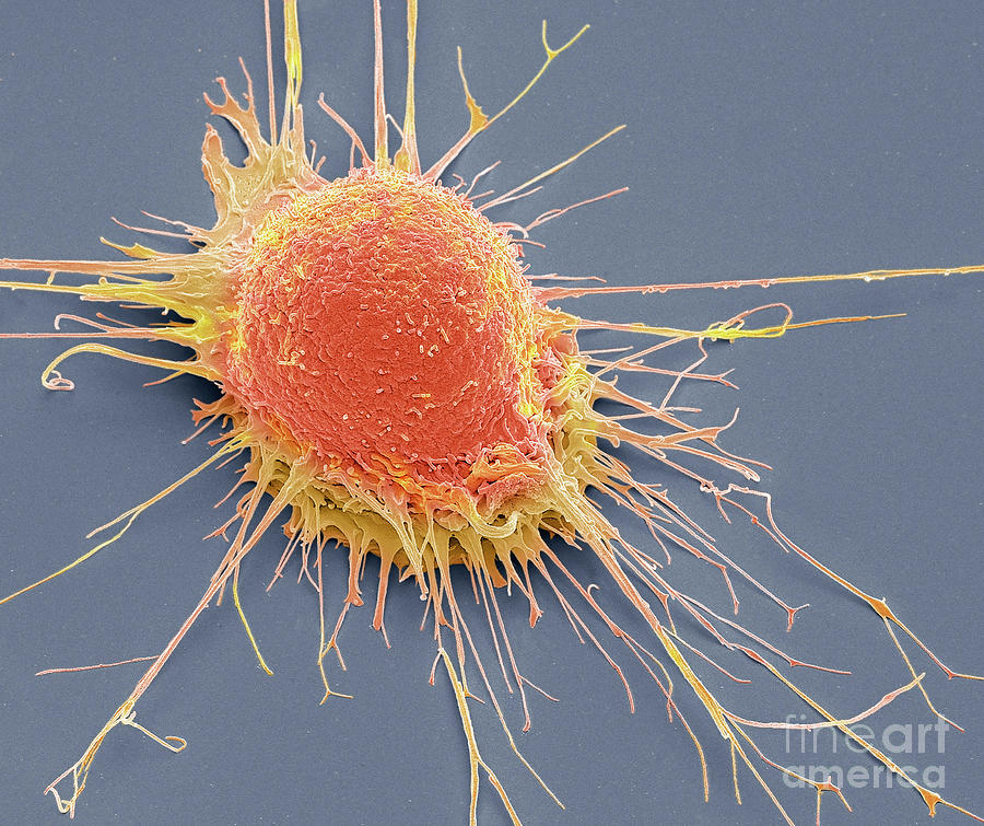 Prostate Cancer Cell Photograph By Steve Gschmeissnerscience Photo Library Pixels 9118