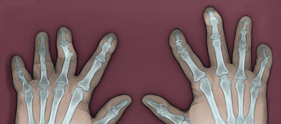Psoriatic Arthritis, X-ray #4 Photograph by Steven Needell
