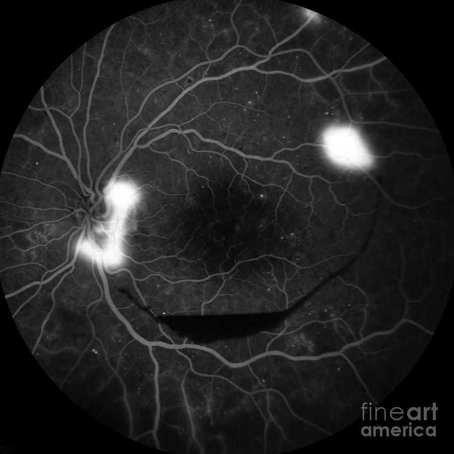Retina Damage From Diabetes #4 Photograph by Alan Frohlichstein/science Photo Library