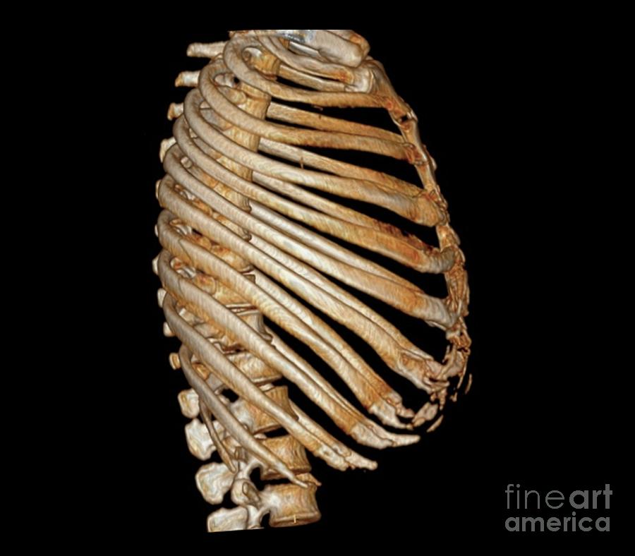 Rib Cage #4 by Zephyr/science Photo Library