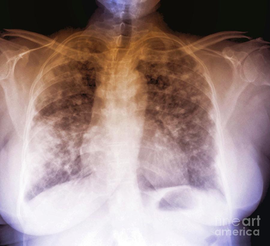 secondary-lung-cancer-photograph-by-zephyr-science-photo-library-pixels