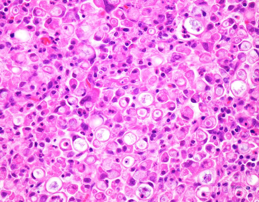 Signet Ring Cell Carcinoma Of The Colon Photograph by Webpathology ...