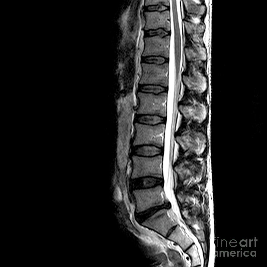 Slipped Disc #4 Photograph by Simon Fraser/science Photo Library