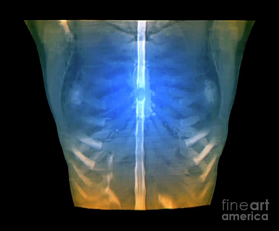 Back Photograph - Spinal Cord Tumour #4 by Zephyr/science Photo Library