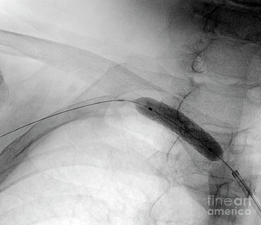 Treatment Of Reduced Blood Flow #4 Photograph by Zephyr/science Photo Library