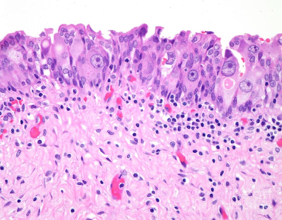 urothelial-carcinoma-in-situ-photograph-by-webpathology-science-photo