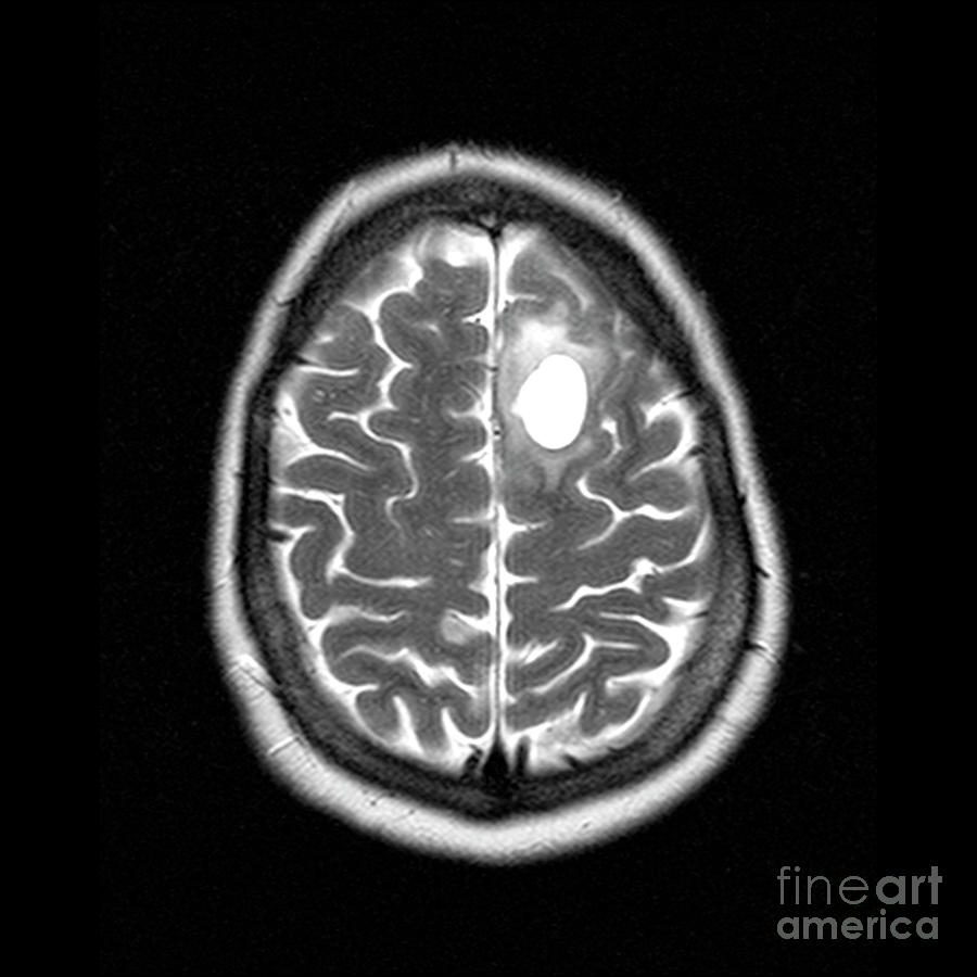 Brain Tumour 41 By Simon Fraserscience Photo Library 1841