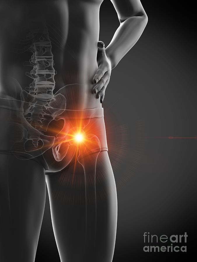 3d Photograph - Hip Pain #43 by Sebastian Kaulitzki/science Photo Library