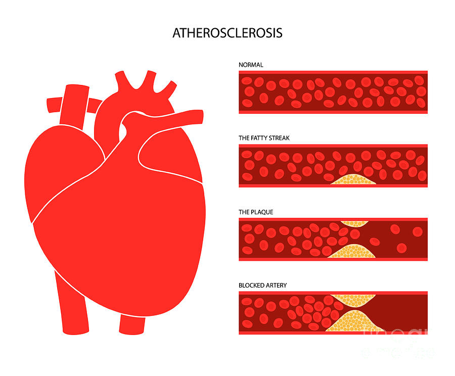 Atherosclerosis Photograph by Pikovit / Science Photo Library - Fine ...