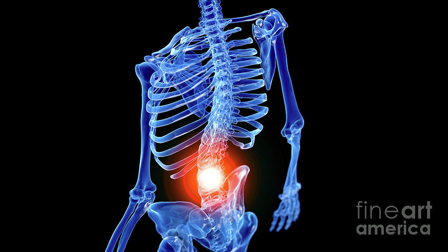 Painful Back #47 Photograph by Sebastian Kaulitzki/science Photo Library