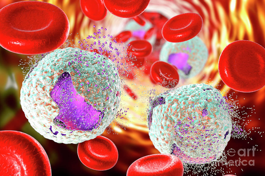 Abnormal Photograph - Acute Lymphoblastic Leukaemia Treatment 5 by Kateryna Kon/science Photo Library Abnormal Photograph - Acute Lymphoblastic Leukaemia Treatment 5 by Kateryna Kon/science Photo Library