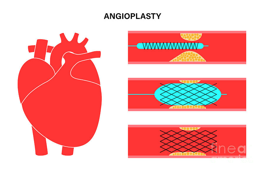 Angioplasty Photograph By Pikovit Science Photo Library Fine Art America 2834