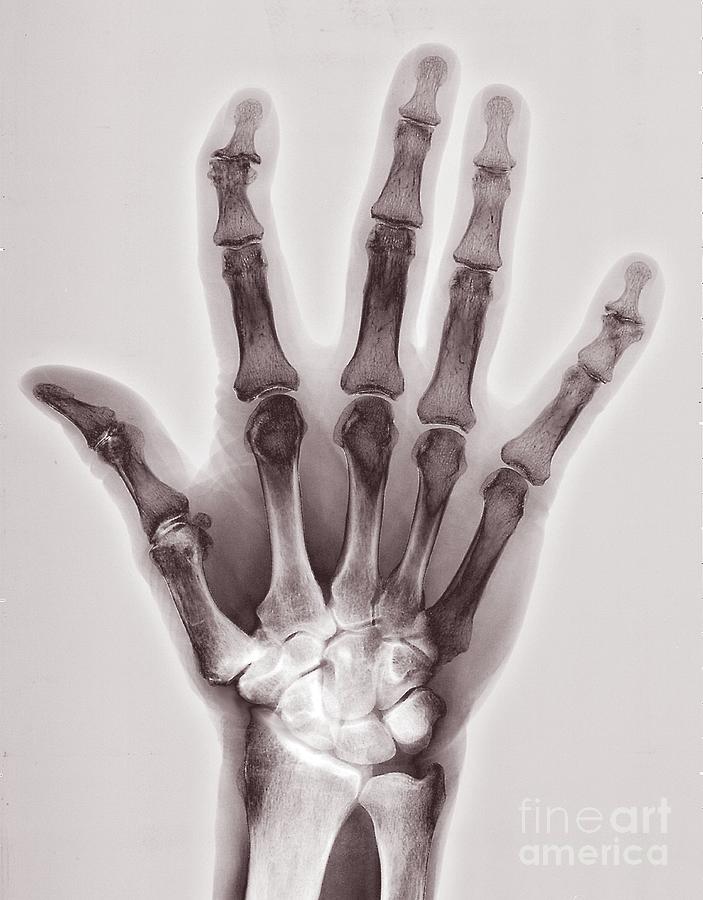 Arthritic Hand Photograph by Zephyr/science Photo Library - Fine Art ...