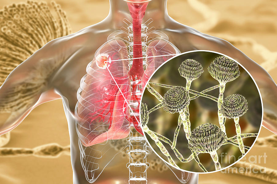 Aspergilloma Of The Lung #5 Photograph by Kateryna Kon/science Photo ...
