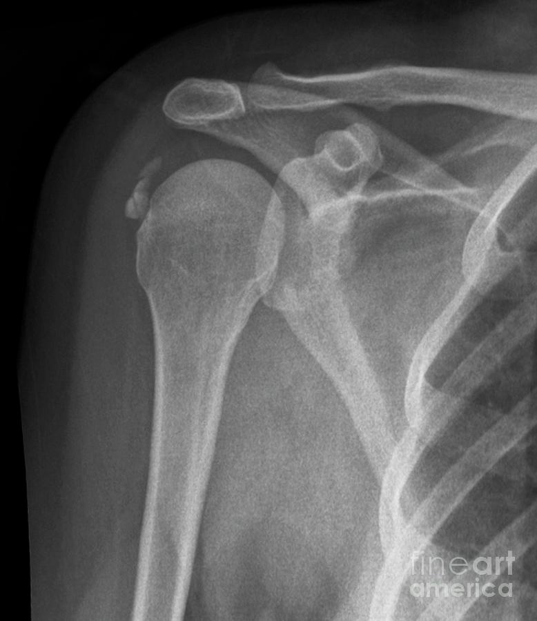 Calcified Tendinitis #5 Photograph by Zephyr/science Photo Library