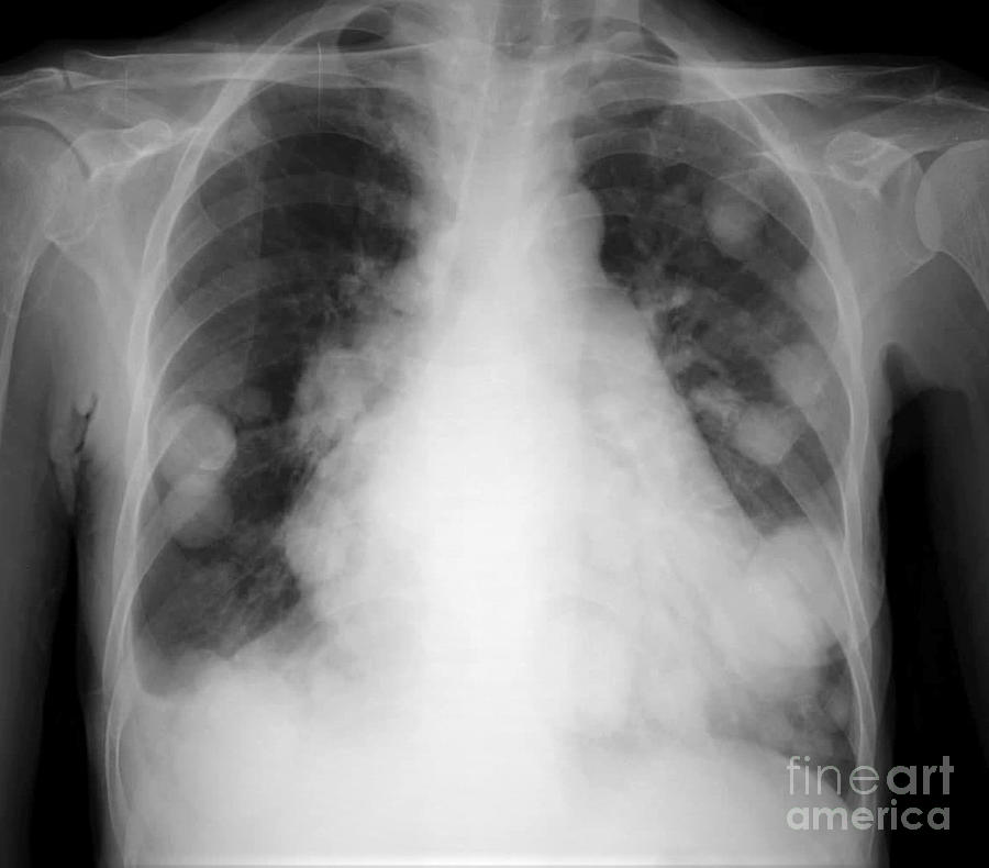 Cannonball Pulmonary Metastases Photograph by Rajaaisya/science Photo ...