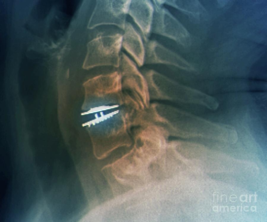 Abnormal Photograph - Cervical Intervertebral Disc Implant #5 by Zephyr/science Photo Library
