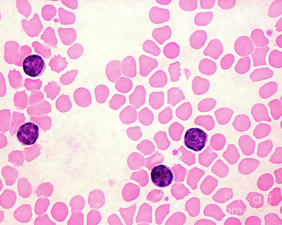 Chronic Lymphocytic Leukaemia Photograph By Jose Calvo Science Photo