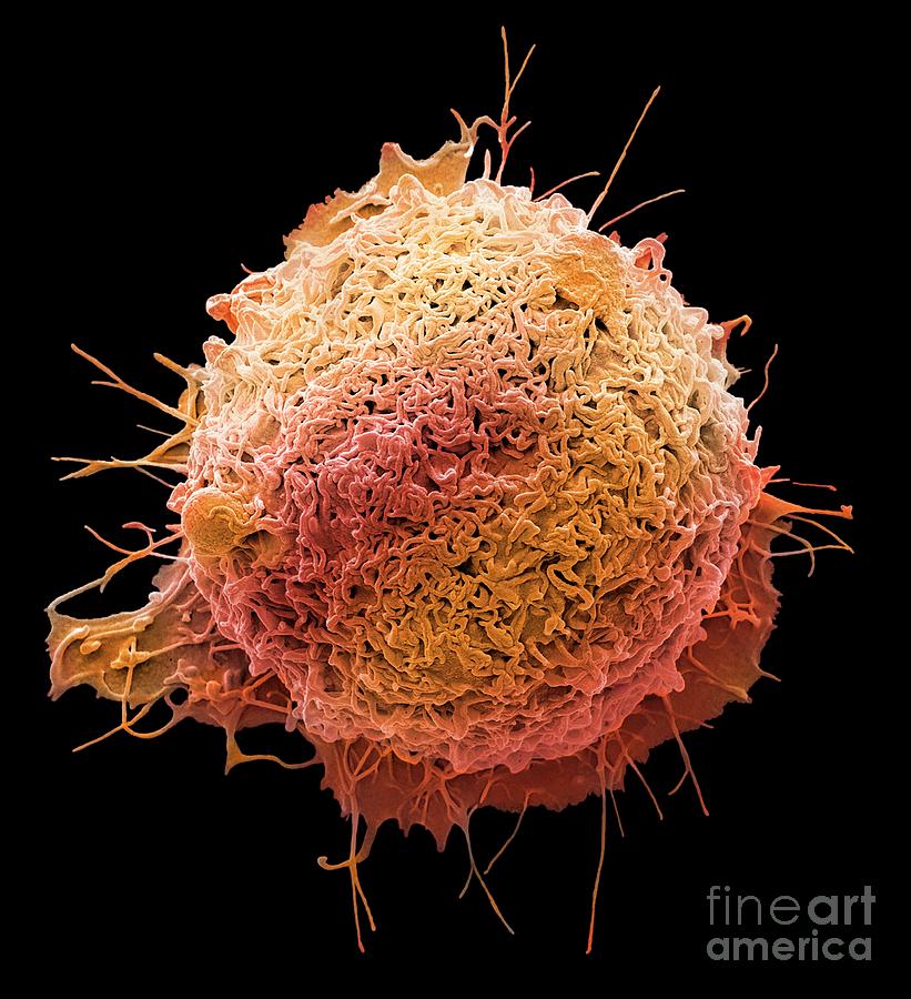 colon cancer cells under microscope