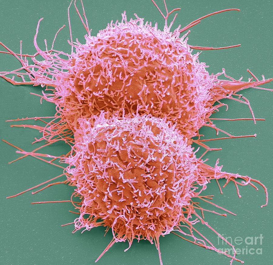 Colorectal Cancer Cells #5 by Steve Gschmeissner/science Photo Library