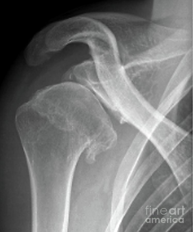 Complications Following Dislocated Shoulder In Sports Injury #5 by ...