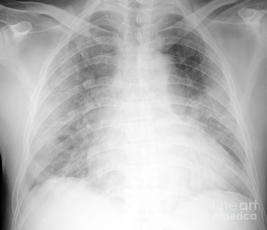 Covid-19 Pneumonia Photograph by Rajaaisya/science Photo Library - Fine ...