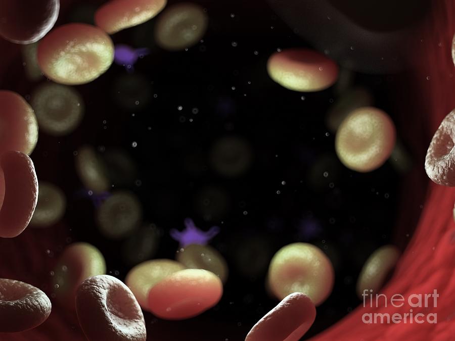 Diseased Blood Cells Photograph by Sebastian Kaulitzki/science Photo ...